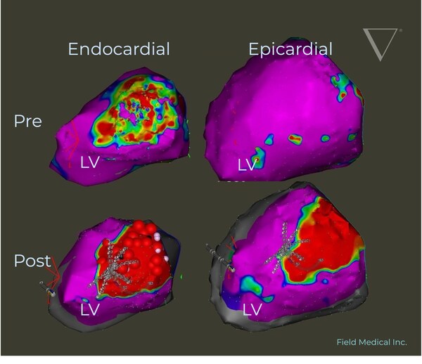 Field_Medical_FieldForce_PFA___Full_Thickness_Endocardial_Ablation.jpg